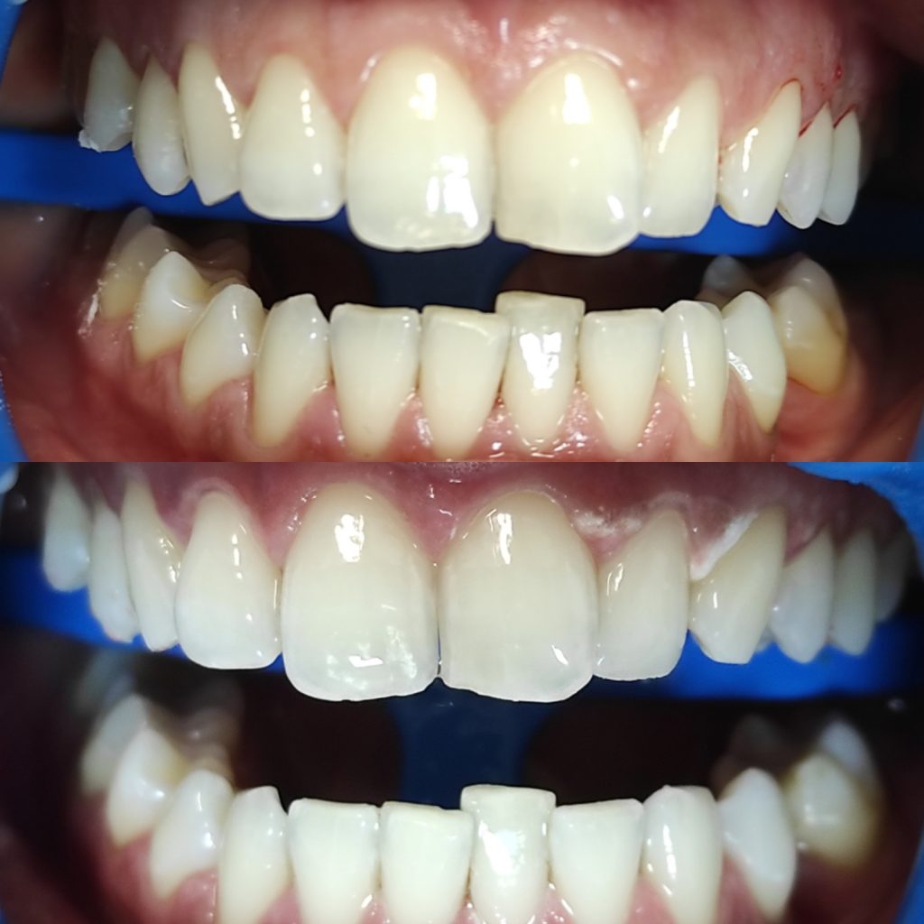 Pre e post trattamento sbiancante dentale professionale