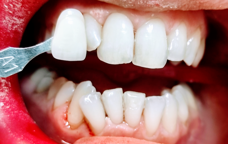 colore finale post sbiancamento dentale professionale